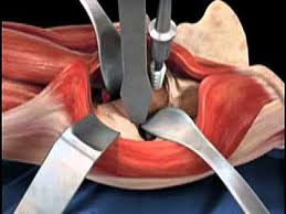 Anterior Hip Procedure images