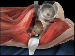 Anterior Hip Replacement index.jpg Anterior Hip Replacement index