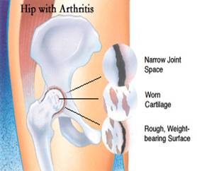 Arthritic Hip