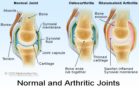 arthritic_joints.jpg Arthritic joints