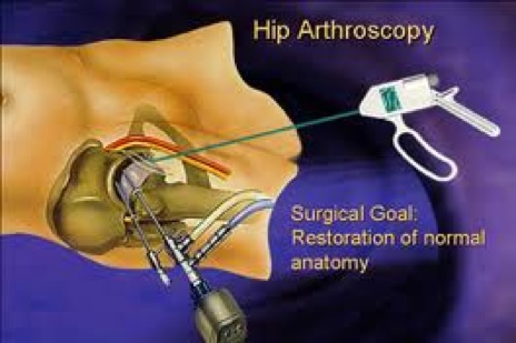 Arthroscopic Hip Surgery images