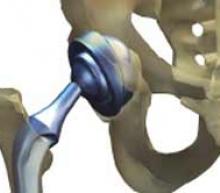 Depuy ASR hip-implant