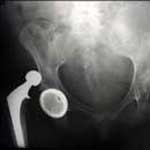 Depuy hip dislocation 02