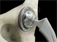 Depuy hip implant failure recall