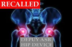 Depuy Recall 3 images