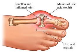 gout images.jpg Gout images