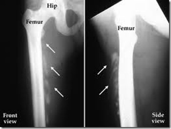 heterotopic ossification