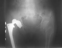 Hip Dislocationimages