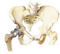 Hip Implant images