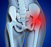 Hip Pain 26 4193R 882