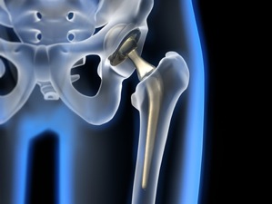 Hip prosthesis