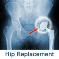 Hip Repl X ray images