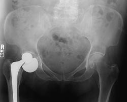 Loosening of Prosthesis images