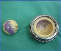 Stryker Hip Implant REcall images.jpg Stryker Hip Implant REcall images