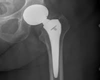 Wright's Profemur® Z hip implant