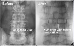XLIF b4 and After index