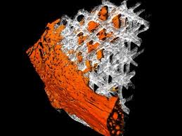 3D Bone Ingrowth