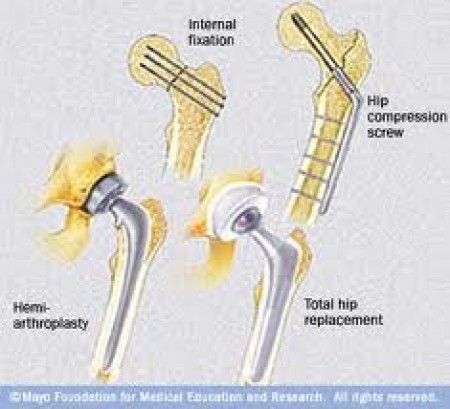 Hemiarthroplasty 2