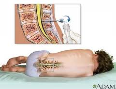 intrathecal pain relief
