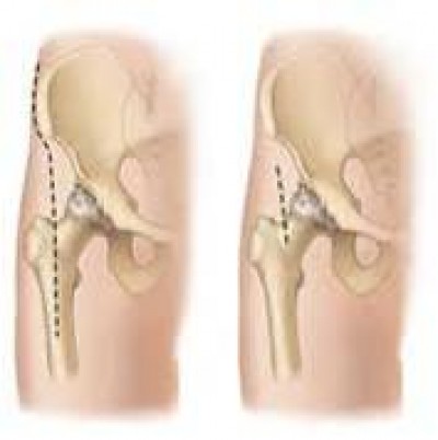 MInimally Invasive Hip Replacement 2