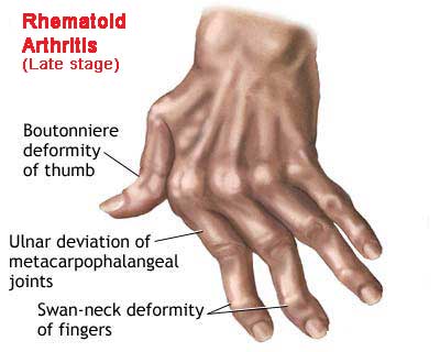 Rhuematoid Arthritis