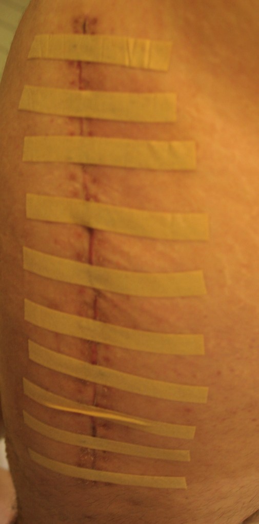 Wound Day 20 - 21 Sept 2011